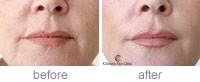Sally Restylane lower face before and after