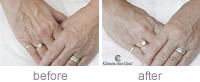 Restylane Vital hands treatment before and after