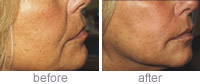 Collagen Stimulating Therapy before and after