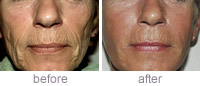 Sculptra treatment before and after