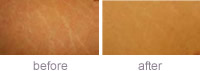 Stretch marks. Improvement after four Genuine Dermaroller� procedures