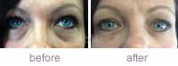 Tear Trough Before & after