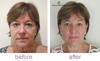 Restylane tear trough before and after