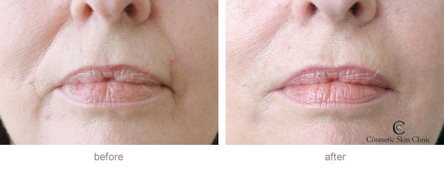 skin treatment voucher gallery Before fillers Dermal : after and
