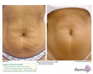 Thermage Abdomen Before and After