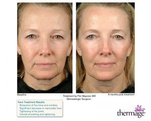 Thermage - Mid/Lower face and neck treatment