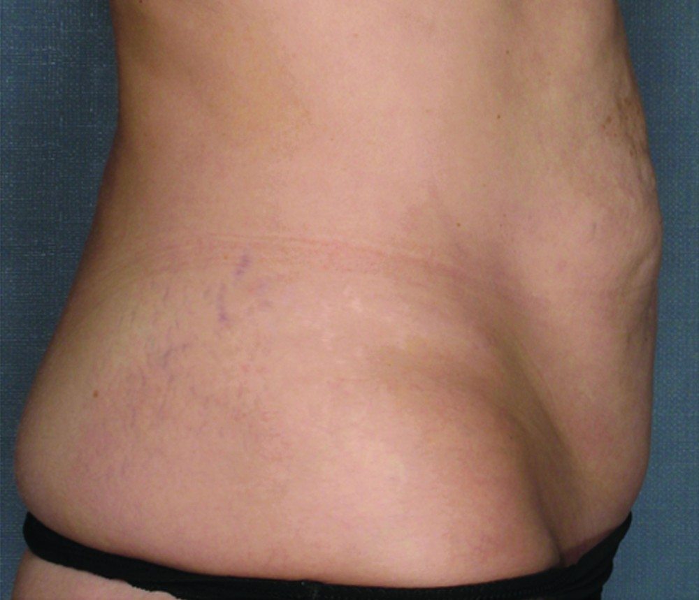 After VelaShape II™
