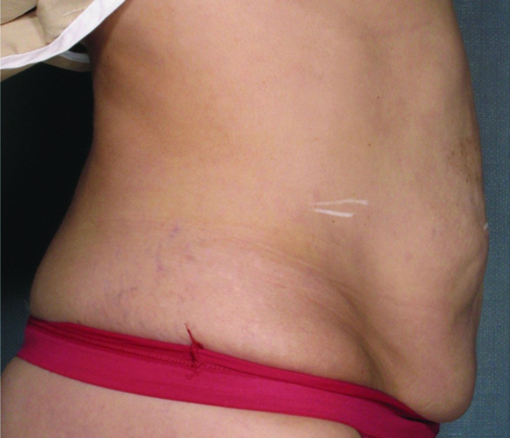 Before VelaShape II™