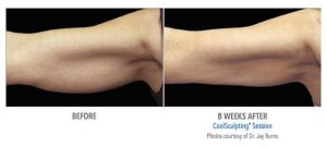 Before & After images of the upper arms after being treated with the new CoolAdvantage Petite applicator