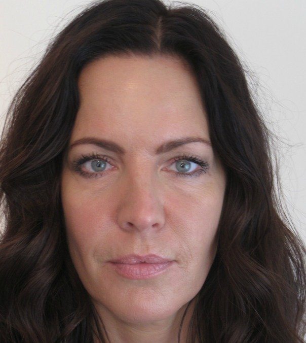 A lady's face following Botox treatment and dermal fillers, including tear trough, nose-to-mouth lines and smile lines