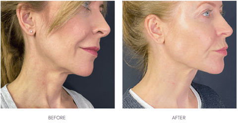 Alice Hart-Davis wrinkly neck SkinTyte and Profhilo before and after