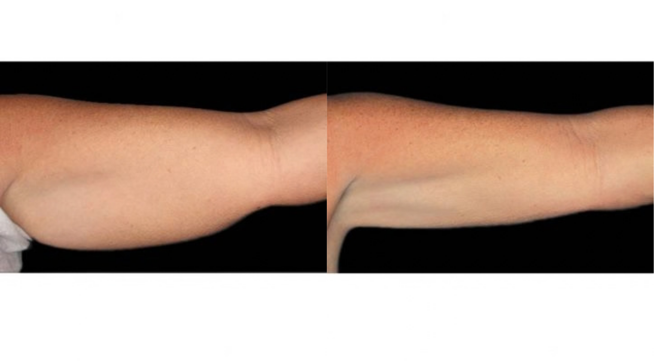 Non-surgical arm lift