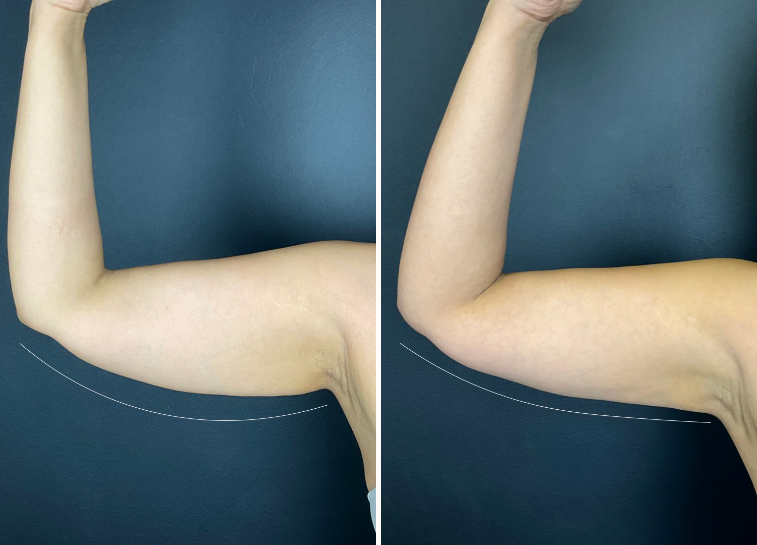 Non-surgical arm lift