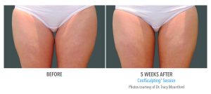 coolsculpting thigh gap before and after results