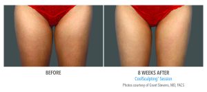 coolsculpting gap between legs before and after