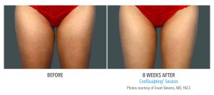 How to Get a Thigh Gap: Healthy Ways to Achieve This Look