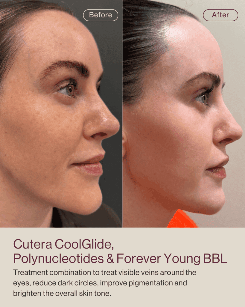 BBL combi treatments - skin pigmentation before and after - post summer skin