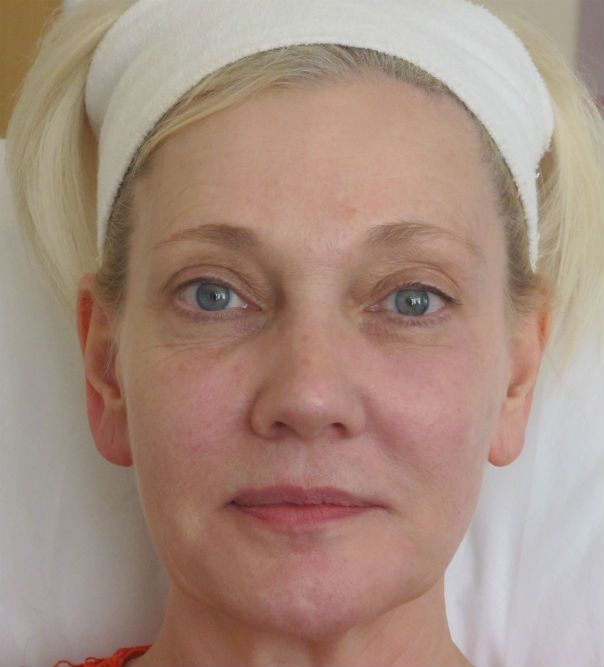 A close up of a lady's face following Juvederm Vycross treatment and muscle relaxant to the forehead and crow's feet