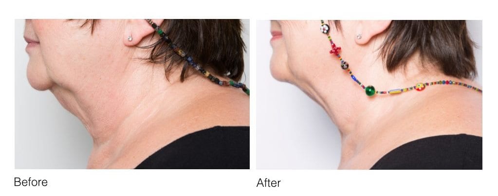 CoolSculpting chin before and after