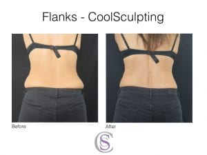 Before & After CoolSculpting treatment to the flanks