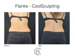 CoolSculpting Before and After treatment on love handles Before & After CoolSculpting treatment to the flanks