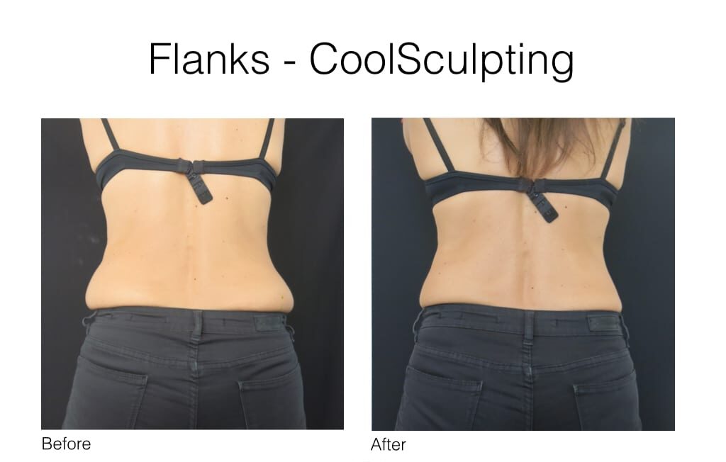 Before & After CoolSculpting treatment to the flanks