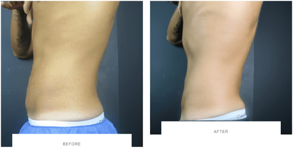coolsculpting abdomen before after side