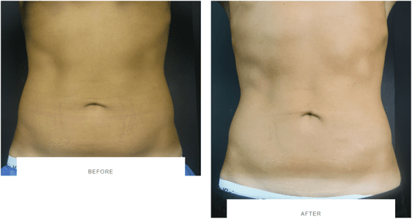 coolsculpting abdomen before after front