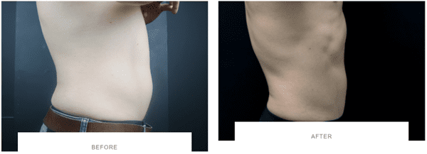 coolsculpting belly fat before after side