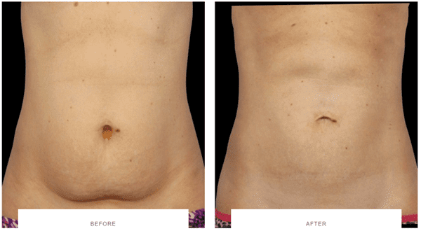 coolsculpting mummy tummy before after