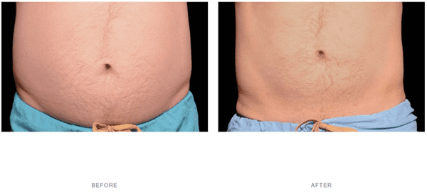 coolsculpting stomach fat before after