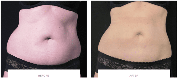 coolsculpting stubborn belly fat before after