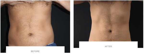 coolsculpting abdomen before after
