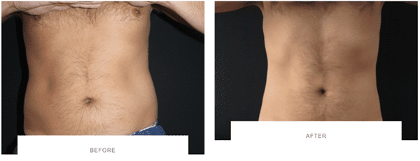 Breast lift Treatment in Beaconsfield,Amersham,Chalfont,Buckinghamshire