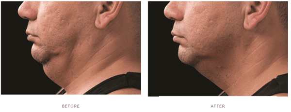 coolscupting double chin before after
