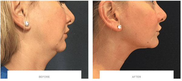 coolsculpting coolmini under chin before after