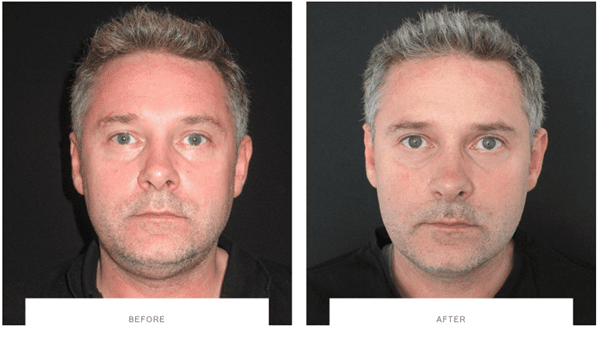 coolsculpting double chin male patient before after