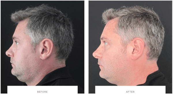 coolsculpting double chin male patient before after side