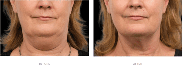 coolsculpting double chin before after results