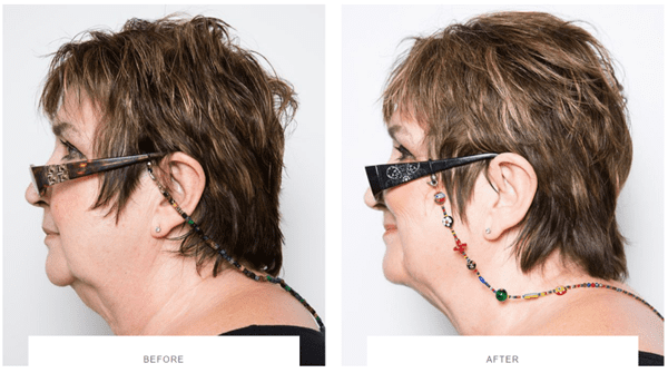 coolsculpting under chin fat, coolsculpting double chin before after