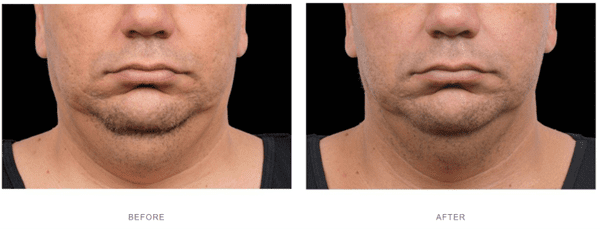 coolsculpting under chin before after