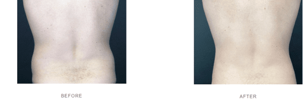 Coolsculpting flanks before after, coolsculpting love handles before after