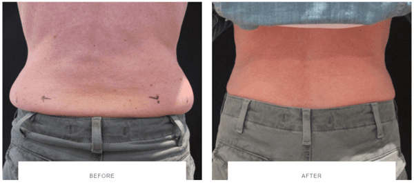 coolsculpting love handles before after, saddlebags before after, coolsculpting flanks