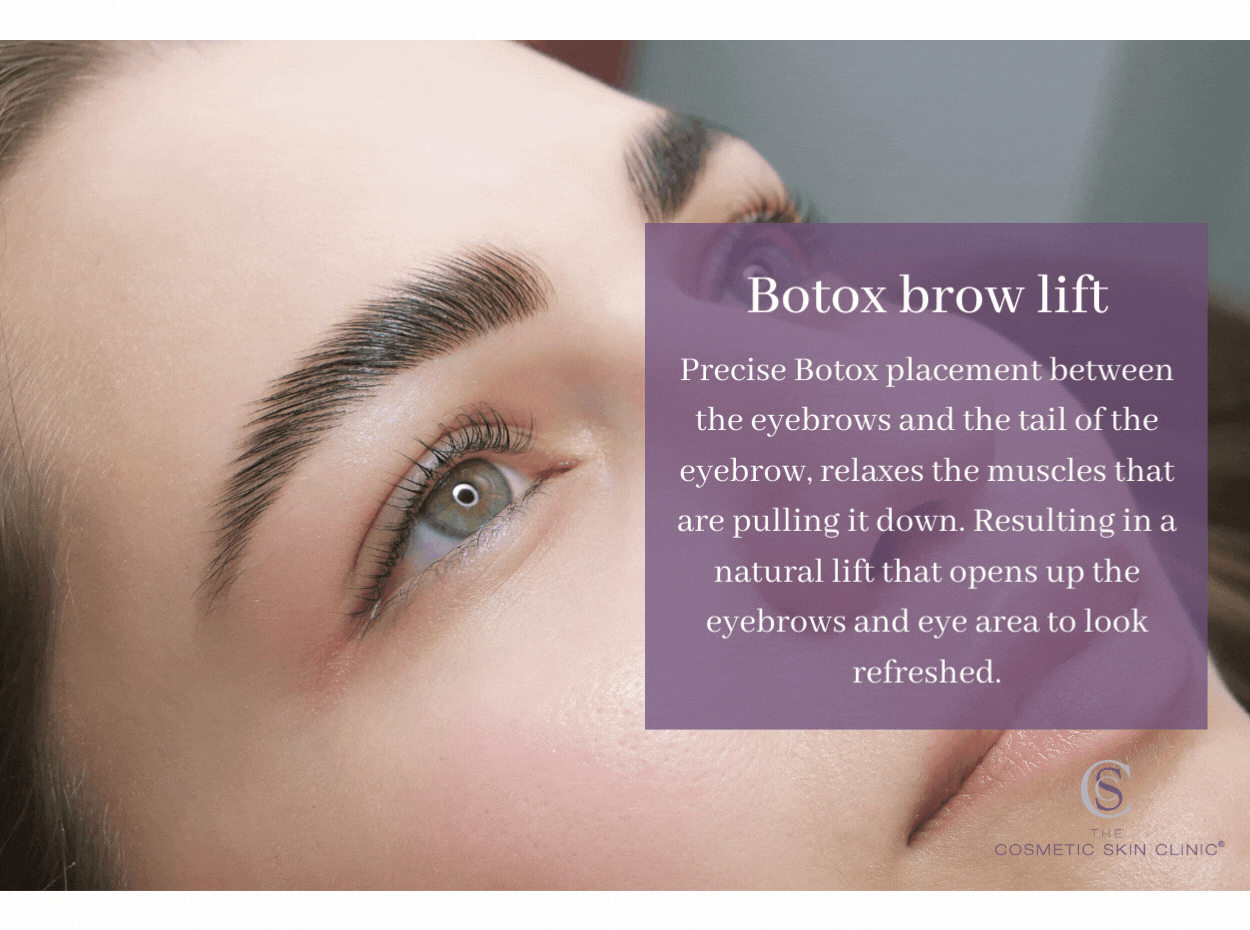 botox brow lift