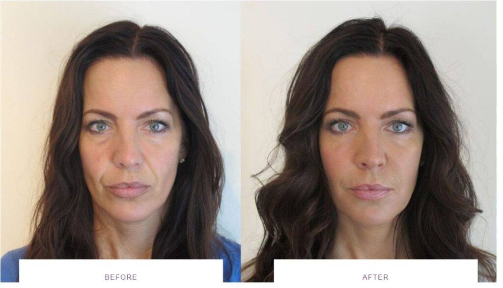 Botox Buckinghamshire - Before and after anti wrinkle injections