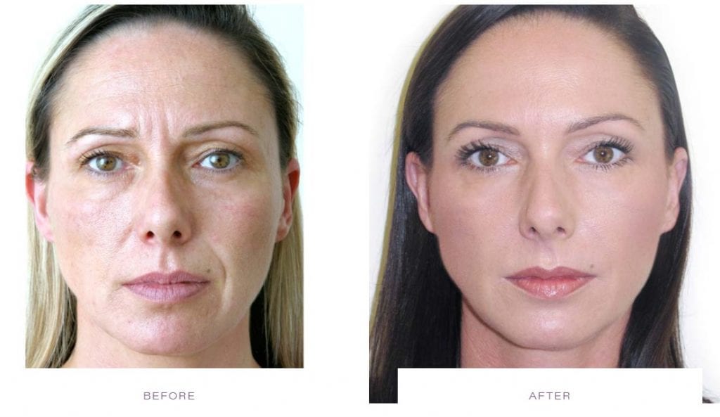 Botox Muscle relaxant before and after