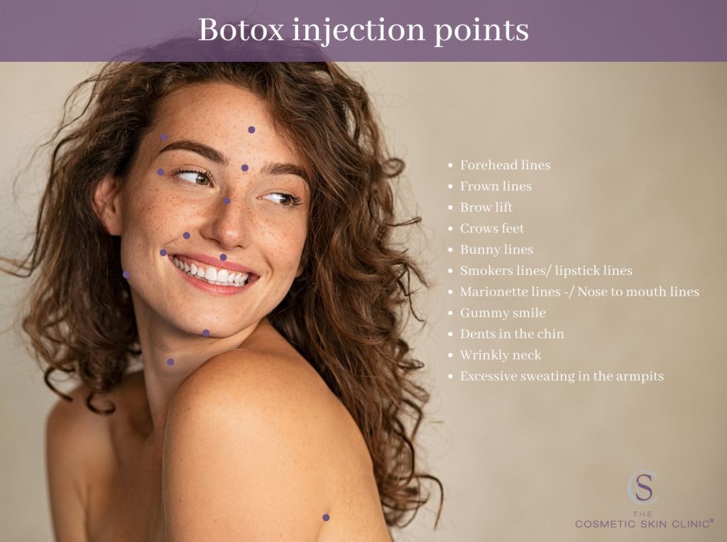 botox treatment areas, botox infographic, botox treatment areas on face