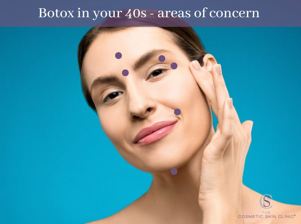 Botox 40s areas, forehead lines, frown lines, upper eye lid botox, nose to mouth lines, smile lines, jowls