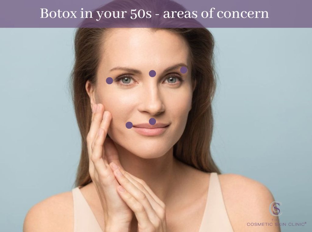 botox 50s areas, crows feet, frown lines, eye lift, downturned corners of the mouth, smokers lines