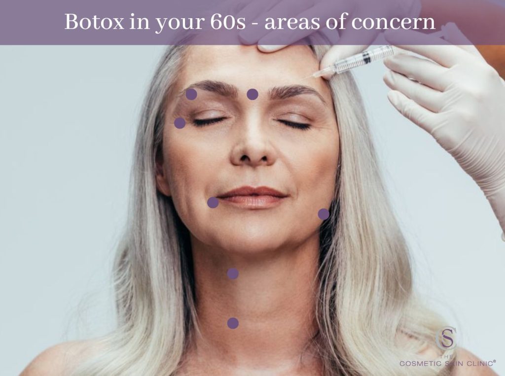 botox 60s areas, botox eye lift, crows feet, frown lines, downturned corners of the mouth, jowls, wrinkly neck